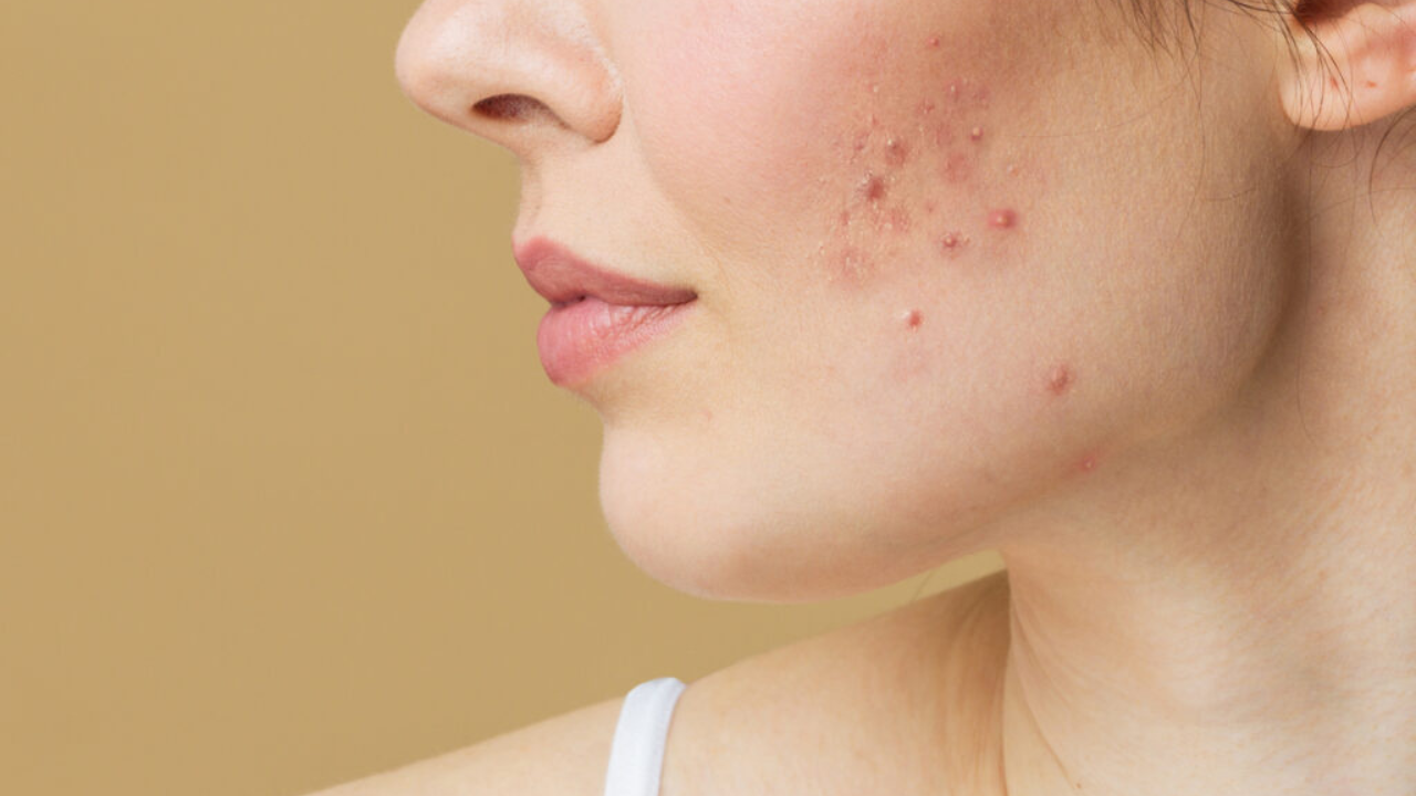 Acne Before and After